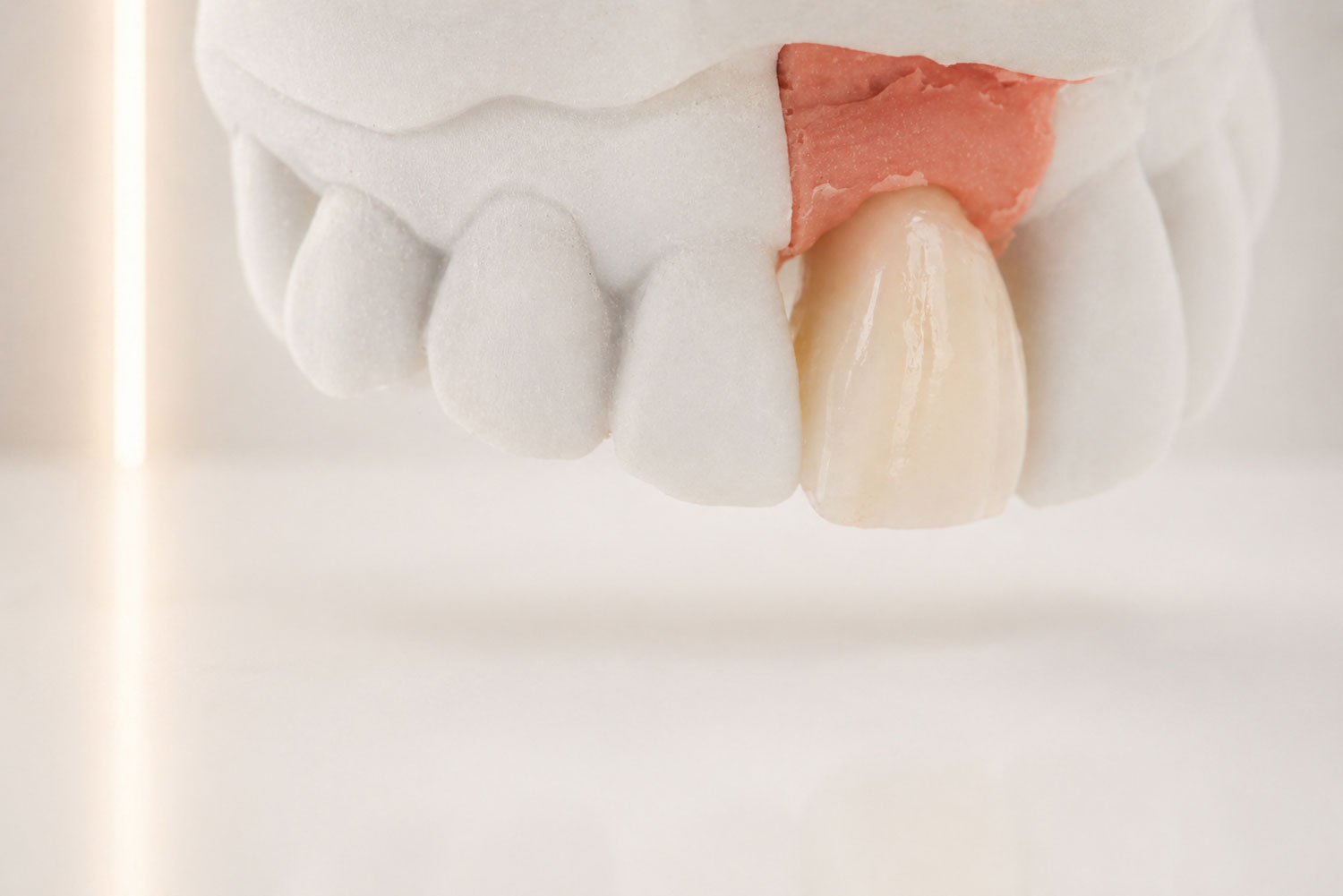Project Dental dental crown fitting model in Rockville, MD